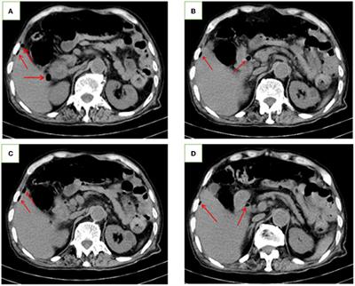 T-Cell Non-Hodgkin Lymphoma of the Ileum Presenting as Perforation and Peritonitis: A Case Report